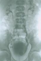 Уретероцеле 7 Уретероцеле 7