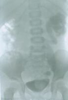 Уретероцеле 6 Уретероцеле 6