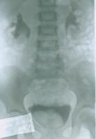 Уретероцеле 5 Уретероцеле 5