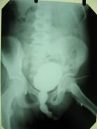 Цистограмма Цистограмма