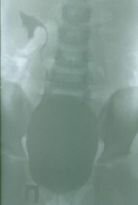 Уретероцеле 10 Уретероцеле 10